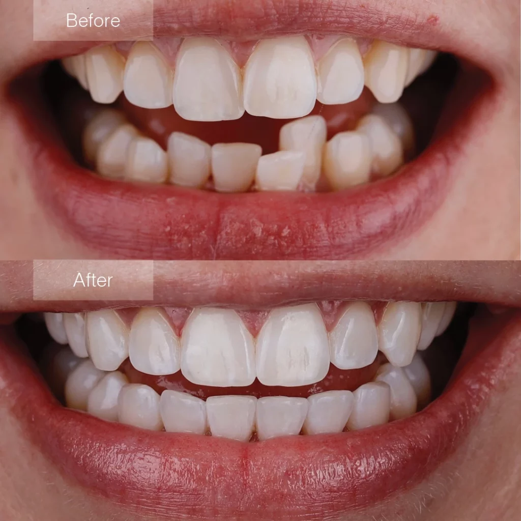 Photo of clear aligners before and after