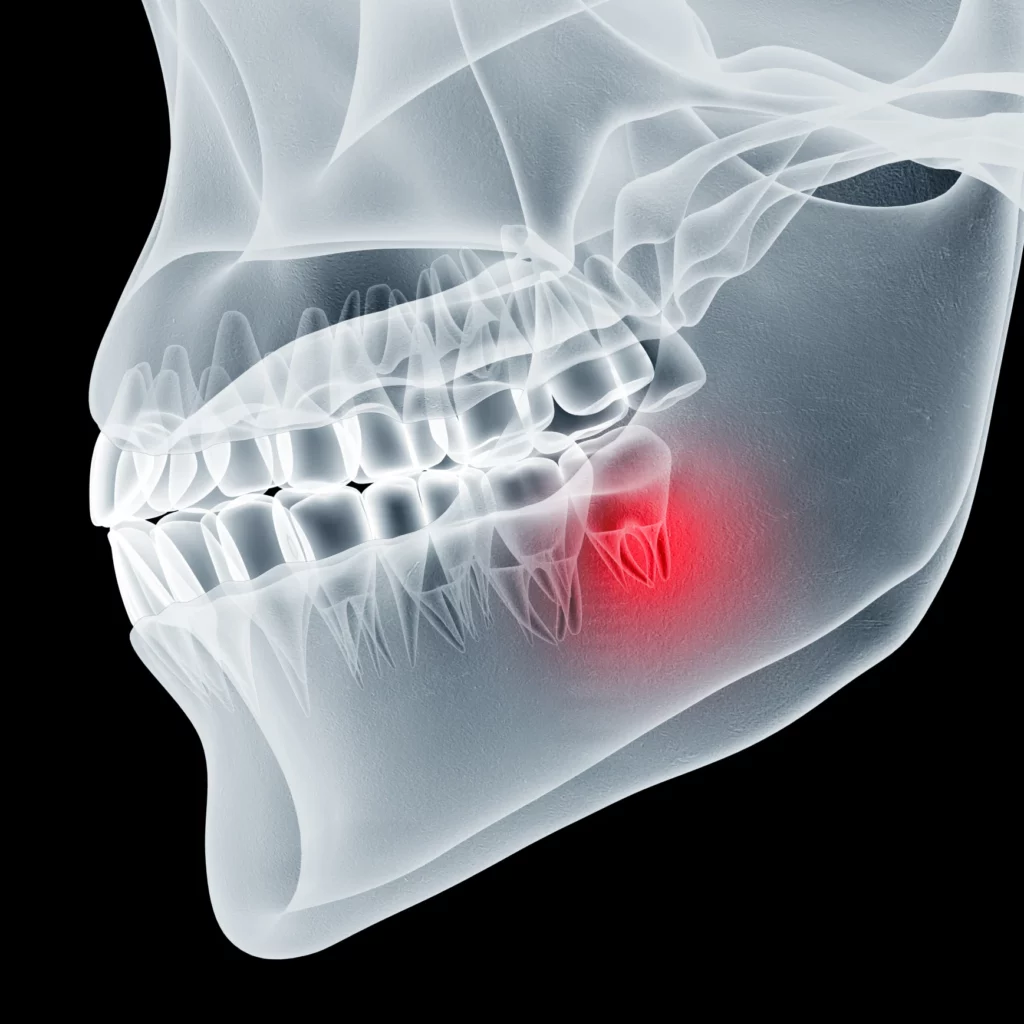 wisdom teeth removal in Wilmington, NC