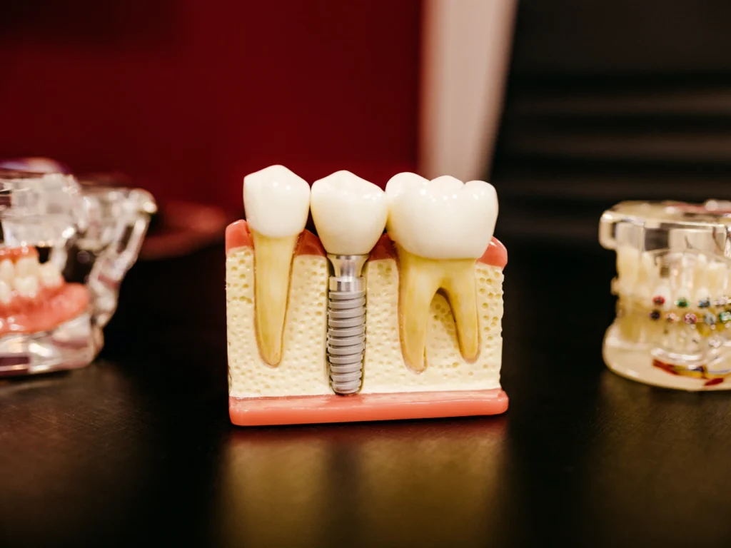 model of a single tooth dental implant | cost of dental implants in Wilmington, NC
