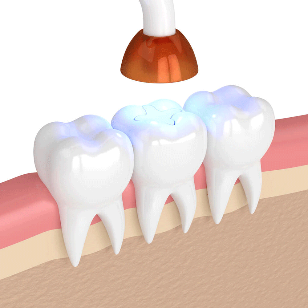 Digital graphic showing a dental filling being set with UV light.