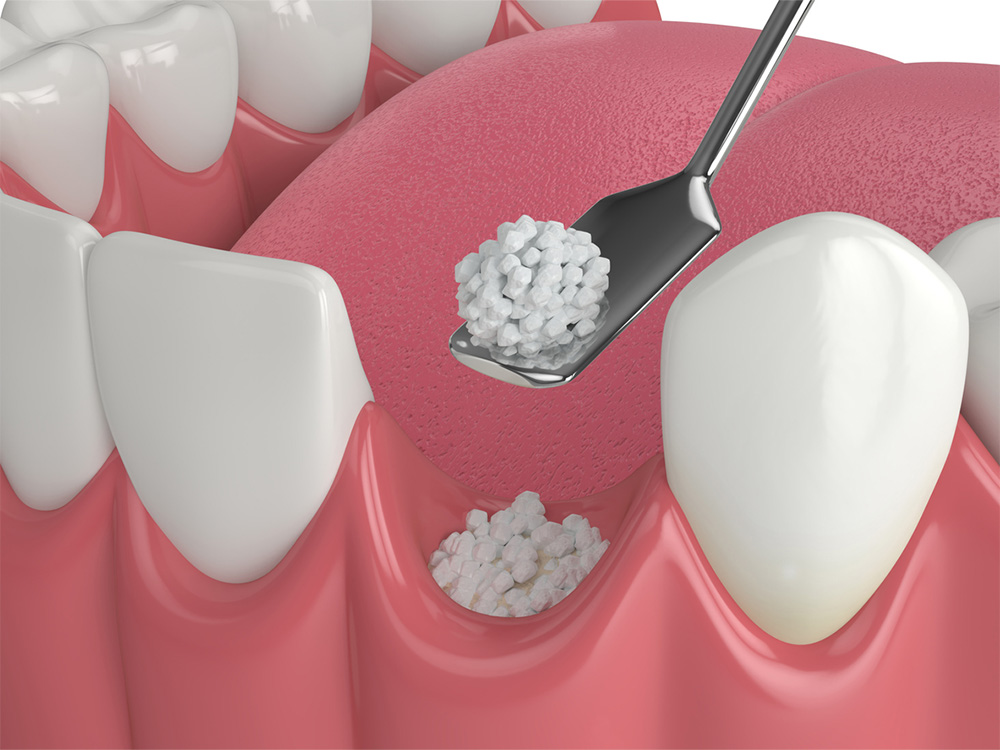 Graphic showing the process of a dental bone grafting procedure.