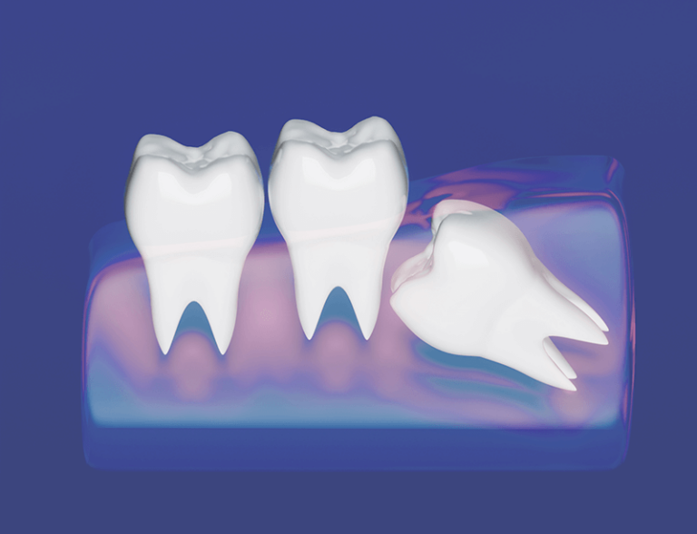 Graphic of an impacted wisdom tooth pushing against other teeth under the skin.