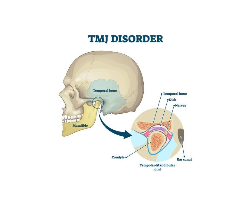 Diagram showing the muscles and joints in the jaw affected by TMJ.